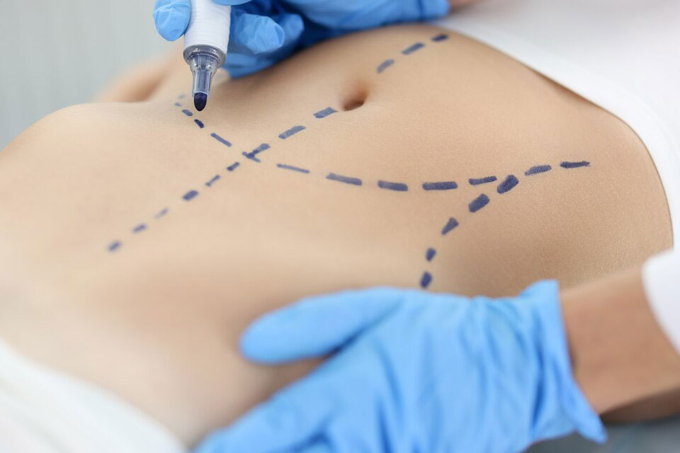 Abdominoplasty