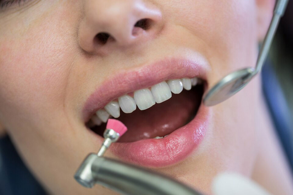 teeth-whitening